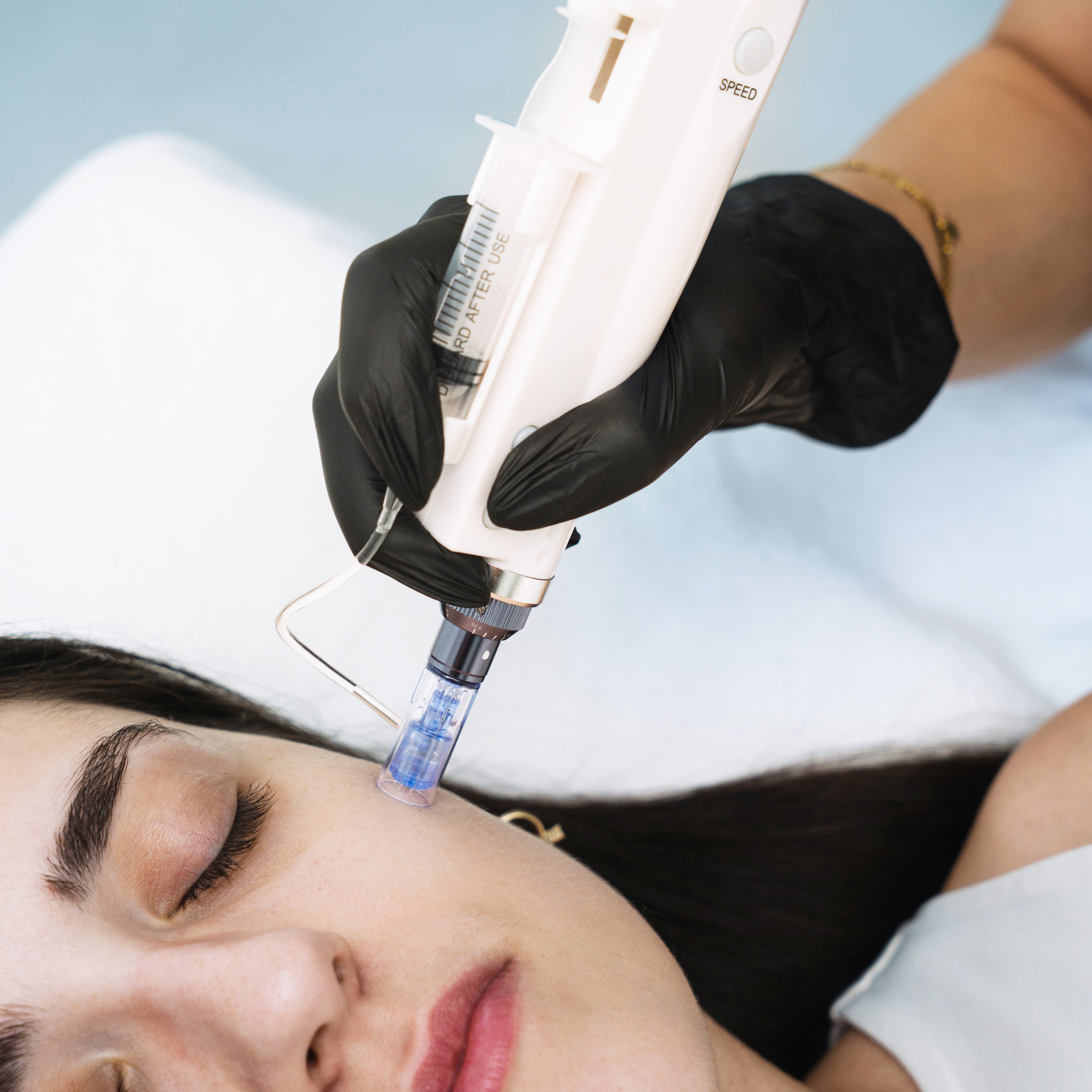 Microagulhamento facial